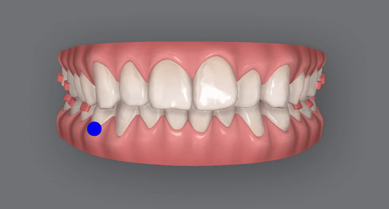 인비절라인을 시작할때 고려해야 하는 세가지 조건 (인비절라인다이아몬드 다이아몬드등급치과 인비절라인앞니교정 앞니급속교정 비발치교정 치간삭제 치간삭제양) 관련 이미지 7