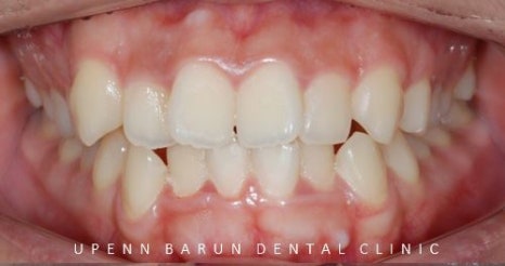 유학생치아교정 유학생교정치과 잠실교정치과 잠실데이몬교정 데이몬클리어교정 Wide Smile (송파교정치과 잠실새내교정치과 강동교정치과 헬리오시티교정치과 예쁜미소 Smile Arc) 관련 이미지 11