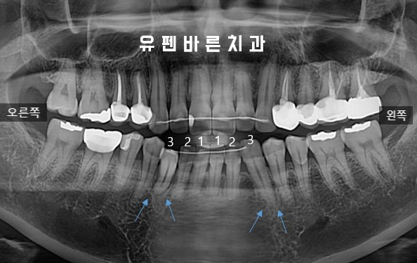 앞니부분교정 잠실인비절라인 라이트 옵션 들어보셨나요? 관련 이미지 4