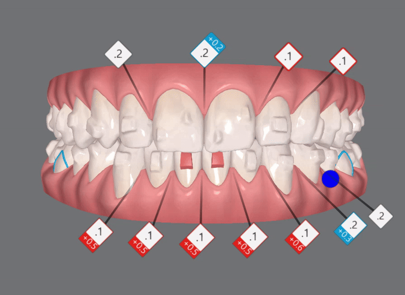 '옥니같이 보여요' 인비절라인급속교정 가능할까? with 캐리에모션장치 (잠실다이아몬드등급 인비절라인다이아몬드등급 서울다이아몬드등급치과 옥니인비절라인후기) 관련 이미지 14