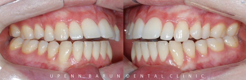 개방교합은 교정용 미니스크류 쓰지말고 인비절라인만으로 쉽게 해결하세요! (잠실인비절라인  잠실새내인비절라인  개방교합교정  잠실새내교정치과) 관련 이미지 5
