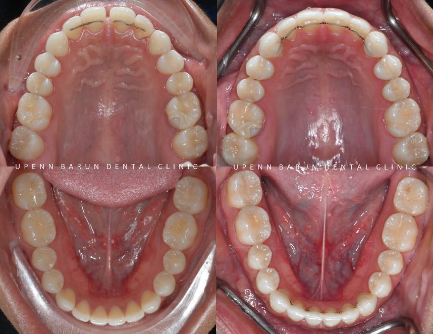 앞니벌어짐 인비절라인익스프레스로 해결하기 (인비절라인앞니부분교정 인비절라인재교정 송파인비절라인 잠실인비절라인 잠실교정치과 인비절라인익스프레스비용) 관련 이미지 17