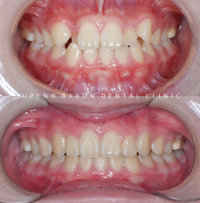 2024년 송파구 단일 치과의원급 중 유일!!! 인비절라인다이아몬드등급 달성한 유펜바른치과의 청소년인비절라인 후기 (청소년반대교합 어린이반대교합 잠실인비절라인잘하는치과) 관련 이미지 5