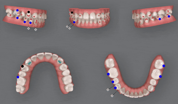 주걱턱 반대교합도 잠실인비절라인 잠실교정치과 유펜바른치과에서!(비발치주걱턱교정 잠실성인교정 반대교합인비절라인 잠실교정치과 주걱턱교정후기) 관련 이미지 11