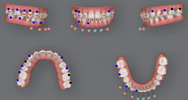 주걱턱 반대교합도 잠실인비절라인 잠실교정치과 유펜바른치과에서!(비발치주걱턱교정 잠실성인교정 반대교합인비절라인 잠실교정치과 주걱턱교정후기) 관련 이미지 18