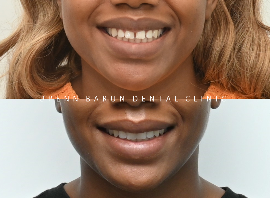 잠실인비절라인등급 잠실부분교정 앞니틈교정 인비절라인라이트 옵션으로 빠르게 해결한 후기 (삼성역부분교정 인비절라인앞니재교정 잠실역교정치과 삼전동인비절라인 삼전동교정치과) 관련 이미지 18