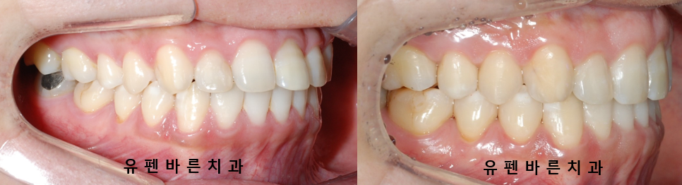 예전에 교정했는데 앞니가 뻐드러져서 컴플렉스에요! ( 비발치교정 인비절라인으로 재교정 해볼까요?) 관련 이미지 12