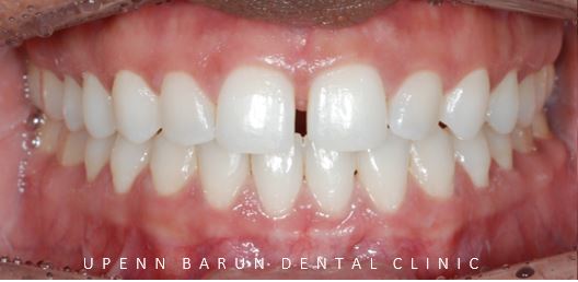 앞니벌어짐 인비절라인익스프레스로 해결하기 (인비절라인앞니부분교정 인비절라인재교정 송파인비절라인 잠실인비절라인 잠실교정치과 인비절라인익스프레스비용) 관련 이미지 6
