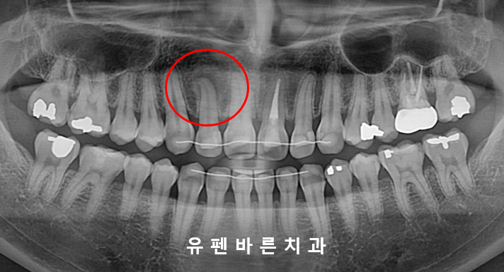 예전에 교정했는데 앞니가 뻐드러져서 컴플렉스에요! ( 비발치교정 인비절라인으로 재교정 해볼까요?) 관련 이미지 4