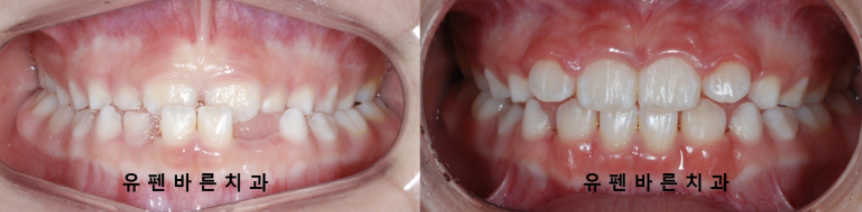 주걱턱교정, 수술교정, 양악수술도 잠실교정치과 유펜바른치과에서 관련 이미지 6