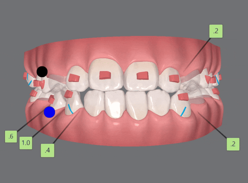 송파인비절라인다이아몬드등급치과 에서 인비절라인으로 1차 2차 교정을 한번에! (송파인비절라인퍼스트 잠실어린이인비절라인 인비절라인소아교정 잠실소아교정 어린이반대교합) 관련 이미지 10