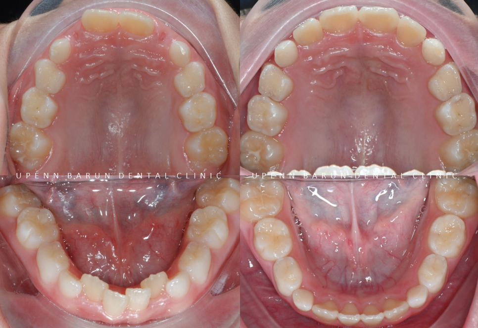 송파인비절라인퍼스트 인비절라인어린이교정 11개월만에 끝낸 후기(잠실인비절라인 잠실파인애플상가교정치과 인비절라인소아교정후기 인비절라인플래티넘엘리트등급) 관련 이미지 22