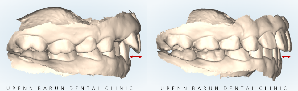 송파인비절라인퍼스트 인비절라인어린이교정 11개월만에 끝낸 후기(잠실인비절라인 잠실파인애플상가교정치과 인비절라인소아교정후기 인비절라인플래티넘엘리트등급) 관련 이미지 8