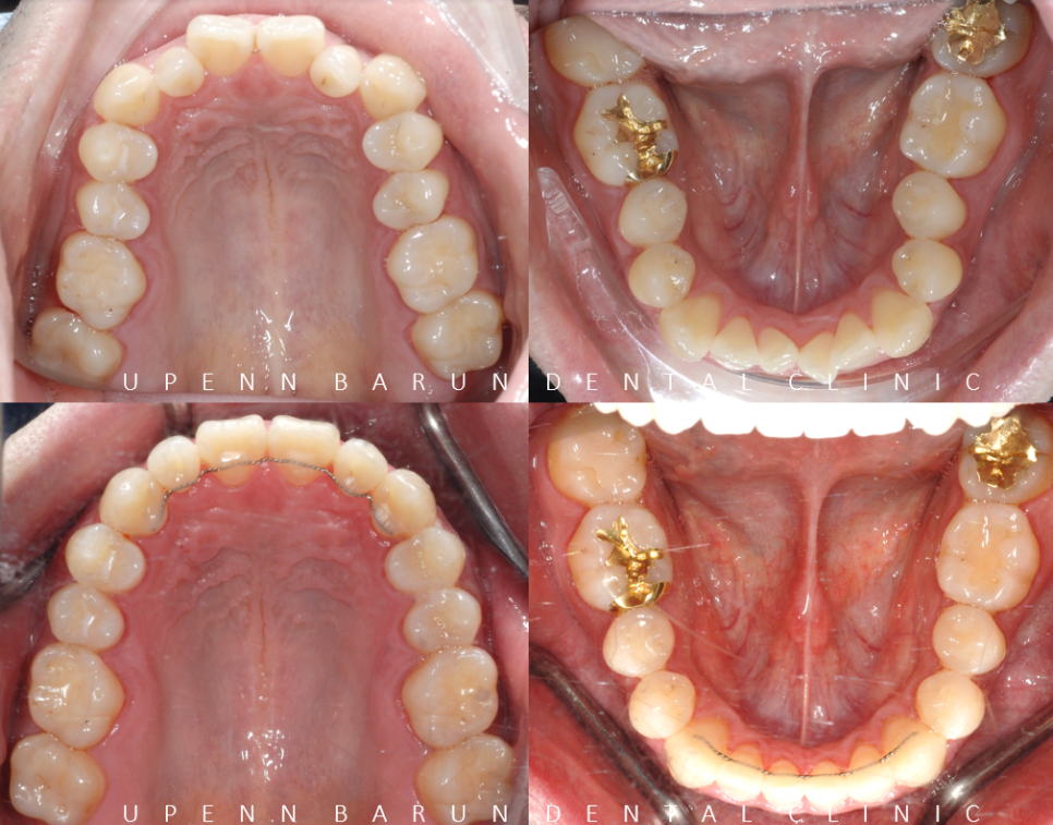 잠실덧니교정 인비절라인으로 컴플렉스 해결! (비발치교정 인비절라인등급 인비절라인후기 ) 관련 이미지 8