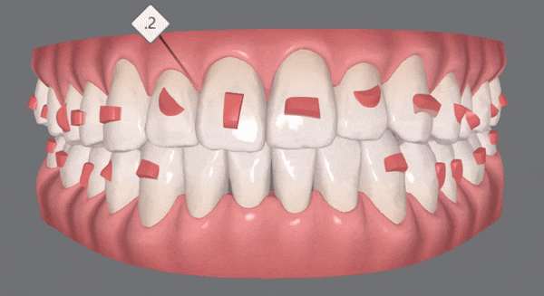 나스닥에 상장한 인비절라인, 잠실투명교정 잠실인비절라인 후기와 치아미백이 궁금하다면? 관련 이미지 12
