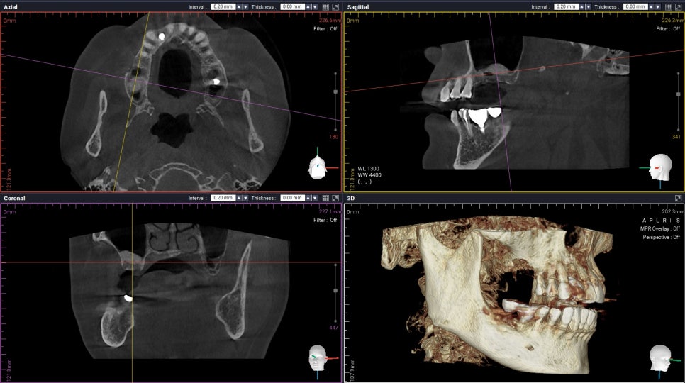 상악동 때문에 대학병원가서 임플란트 하라고 권유받으신 분들 필독!!! 관련 이미지 8