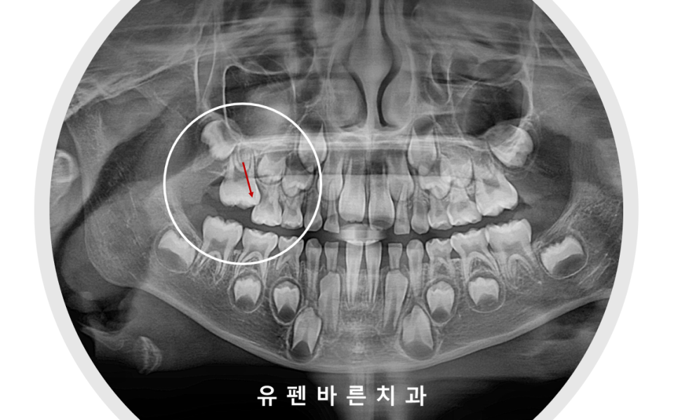 아이가 반대교합(주걱턱)인데 1차교정을 꼭해야 하나요? 관련 이미지 6