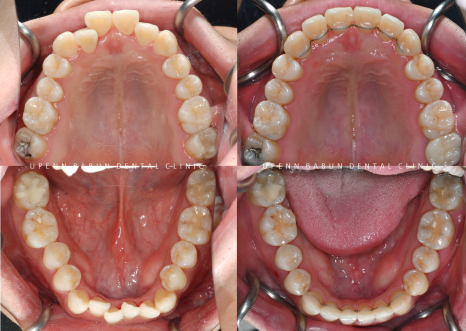 송파인비절라인다이아몬드등급 치과에서 악궁확장장치 없이 반대교합 해결한 후기(인비절라인높은등급 인비절라인반대교합 인비절라인비발치교정 인비절라인잘하는치과 인비절라인교정전문) 관련 이미지 14