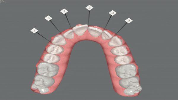 잠실교정치과 유펜바른치과의 인비절라인익스프레스가 특별한 이유 (5개월 인비절라인급속교정 잠실인비절라인 송파인비절라인 인비절라앞니부분교정) 관련 이미지 9