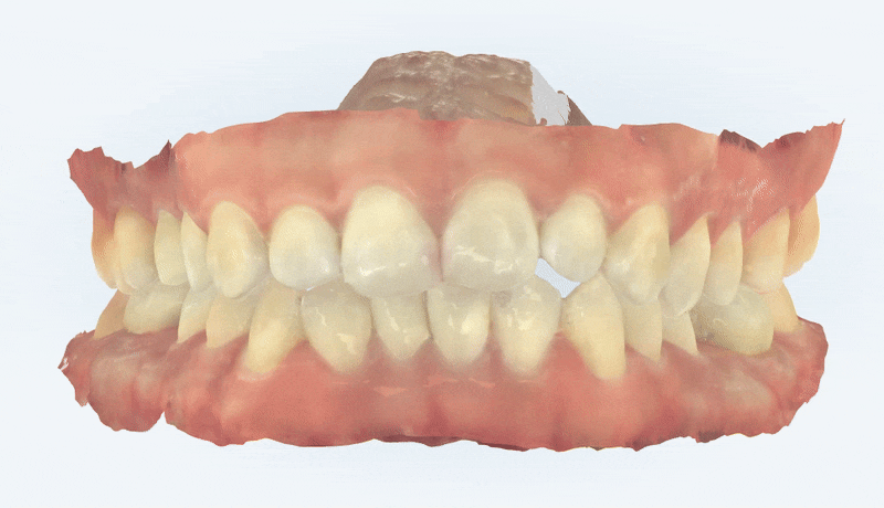 잇몸웃음 거미스마일(gummy smile) 교정후 입동굴 예쁜미소로!(잠실교정치과 거미스마일교정후기 거미스마일교정전후 클라리티세라믹교정 미니스크류교정 미국치과교정과전문의) 관련 이미지 5