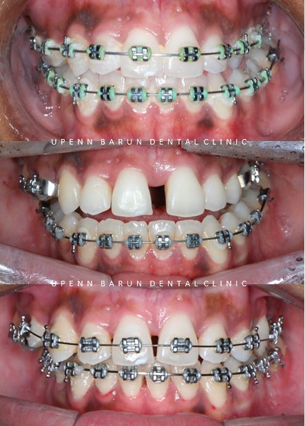 ABO 미국 치과교정과 전문의의 비수술치아교정 악궁확장장치 후기 (잠실교정전후 잠실새내교정치과 잠실교정치과 교정통증  앞니 변화) 관련 이미지 12