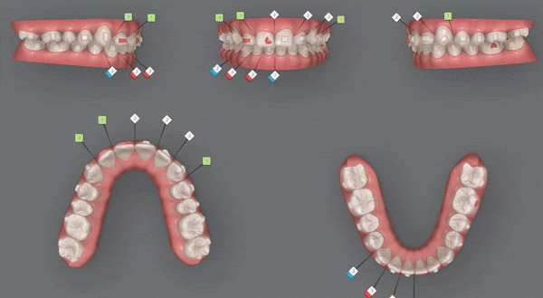 잠실인비절라인등급 잠실부분교정 앞니틈교정 인비절라인라이트 옵션으로 빠르게 해결한 후기 (삼성역부분교정 인비절라인앞니재교정 잠실역교정치과 삼전동인비절라인 삼전동교정치과) 관련 이미지 12