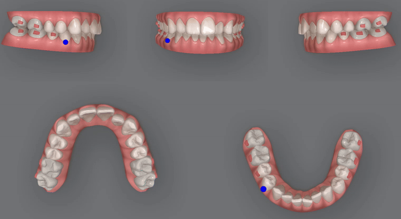 인비절라인을 시작할때 고려해야 하는 세가지 조건 (인비절라인다이아몬드 다이아몬드등급치과 인비절라인앞니교정 앞니급속교정 비발치교정 치간삭제 치간삭제양) 관련 이미지 8