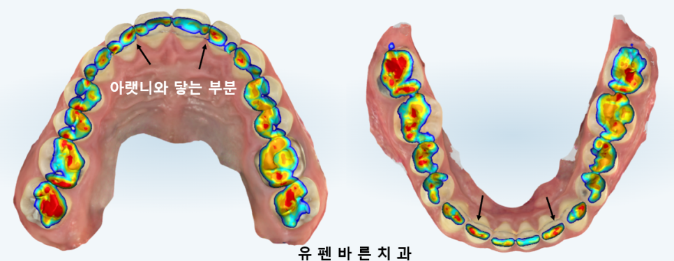 예전에 교정했는데 앞니가 뻐드러져서 컴플렉스에요! ( 비발치교정 인비절라인으로 재교정 해볼까요?) 관련 이미지 3
