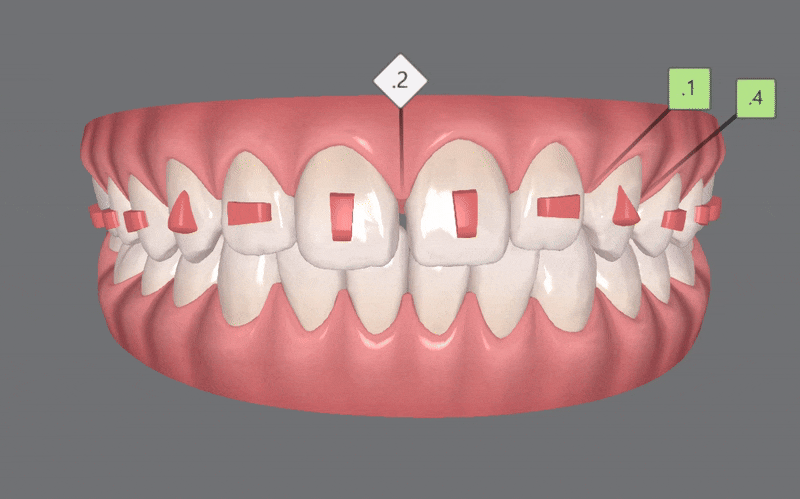 인비절라인다이아몬드등급치과에서 7주만에 앞니벌어짐 고민 해결한 후기(인비절라인앞니교정 인비절라인익스프레스 잠실인비절라인 인비절라인앞니교정후기) 관련 이미지 7
