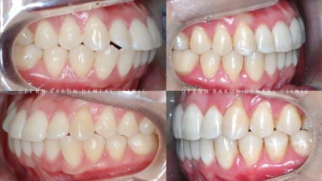 "치아가 앞으로 뻐드러졌어요!" 송파인비절라인다이아몬드등급치과에서!!(비발치인비절라인 뻐드렁니교정치과 돌출입교정치과) 관련 이미지 15