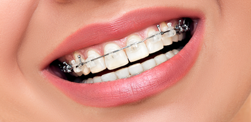 EXPLORING YOUR OPTIONS: DAMON BRACES, CERAMIC BRACES, AND METAL BRACES FOR ORTHODONTIC TREATMENT 관련 이미지 1
