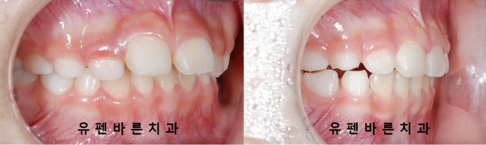저도 친구들이 많이 하는 인비절라인교정 하고싶어요! 관련 이미지 9