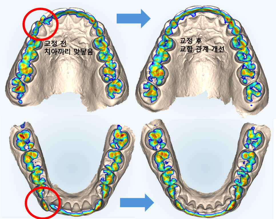 인비절라인다이아몬드등급치과에서 28개의 교정장치로 고민 해결한 후기가 궁금하다면? (잠실송곳니덧니교정 잠실인비절라인 인비절라인교정기간 투명교정장치후기 잠실인비절라인후기) 관련 이미지 13