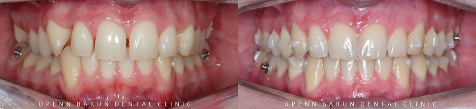 '옥니같이 보여요' 인비절라인급속교정 가능할까? with 캐리에모션장치 (잠실다이아몬드등급 인비절라인다이아몬드등급 서울다이아몬드등급치과 옥니인비절라인후기) 관련 이미지 10