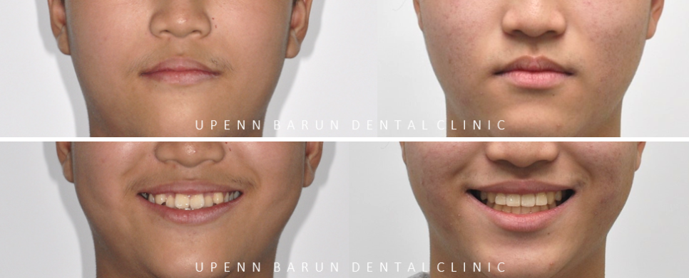 비발치교정 성장기교정 청소년치아교정은 잠실교정치과 유펜바른치과에서 관련 이미지 11