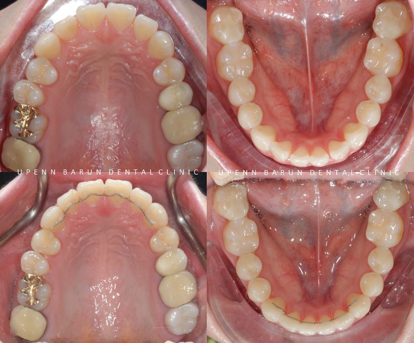 20대 여성 앞니 사이 틈 2개월만에 해결 (인비절라인익스프레스 INVISALIGN EXPRESS 인비절라인후기 잠실인비절라인  잠실투명교정치과) 관련 이미지 11