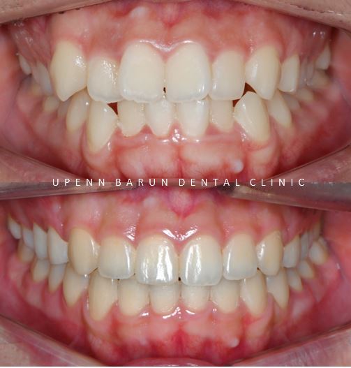 유학생치아교정 유학생교정치과 잠실교정치과 잠실데이몬교정 데이몬클리어교정 Wide Smile (송파교정치과 잠실새내교정치과 강동교정치과 헬리오시티교정치과 예쁜미소 Smile Arc) 관련 이미지 19