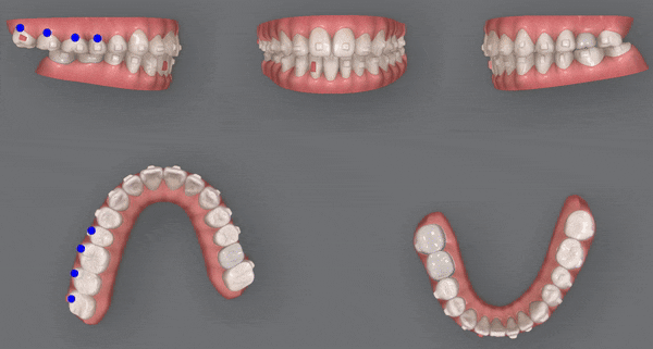 인비절라인 공식 스피커가 상주하고 치료하는 송파교정잘하는치과 유펜바른치과 (잠실성인교정 잠실재교정 잠실인비절라인 성인인비절라인교정 잠실나루역교정치과 문정동교정치과 삼전역교정치과) 관련 이미지 13
