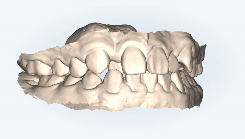 2024년 송파구 단일 치과의원급 중 유일!!! 인비절라인다이아몬드등급 달성한 유펜바른치과의 청소년인비절라인 후기 (청소년반대교합 어린이반대교합 잠실인비절라인잘하는치과) 관련 이미지 4
