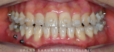 주걱턱 반대교합도 잠실인비절라인 잠실교정치과 유펜바른치과에서!(비발치주걱턱교정 잠실성인교정 반대교합인비절라인 잠실교정치과 주걱턱교정후기) 관련 이미지 17