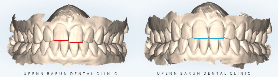 잠실교정치과 유펜바른치과의 인비절라인익스프레스가 특별한 이유 (5개월 인비절라인급속교정 잠실인비절라인 송파인비절라인 인비절라앞니부분교정) 관련 이미지 4