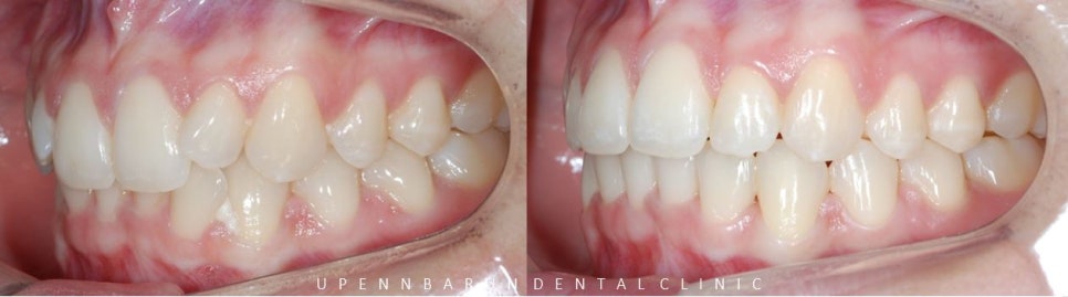 비발치 세라믹교정 후기 (앞니교정 잠실부분교정 잠실교정치과 잠실새내교정치과) 관련 이미지 7