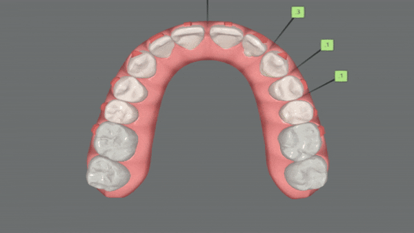 앞니벌어짐 인비절라인익스프레스로 해결하기 (인비절라인앞니부분교정 인비절라인재교정 송파인비절라인 잠실인비절라인 잠실교정치과 인비절라인익스프레스비용) 관련 이미지 8