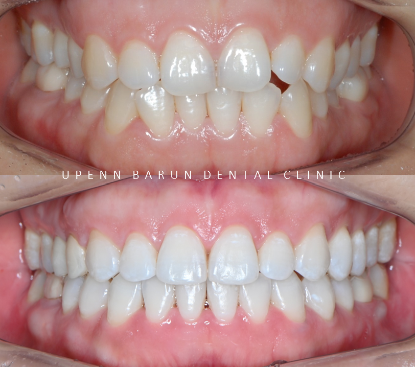 잇몸웃음 거미스마일(gummy smile) 교정후 입동굴 예쁜미소로!(잠실교정치과 거미스마일교정후기 거미스마일교정전후 클라리티세라믹교정 미니스크류교정 미국치과교정과전문의) 관련 이미지 7
