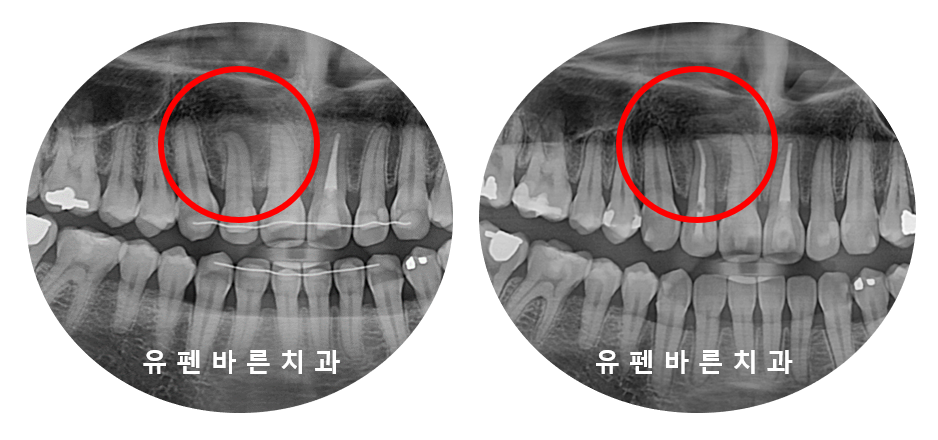 예전에 교정했는데 앞니가 뻐드러져서 컴플렉스에요! ( 비발치교정 인비절라인으로 재교정 해볼까요?) 관련 이미지 6
