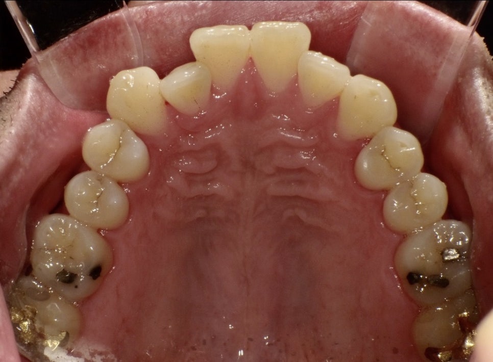 인비절라인의 4가지 종류에 대해 알고 계시나요? 관련 이미지 2