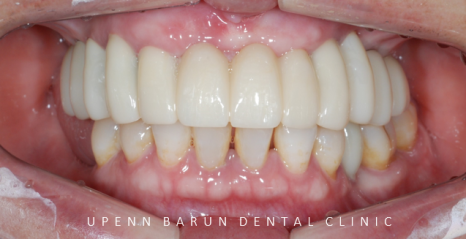 잠실새내역임플란트 잠실새내역치과 유펜바른치과에서 전체임플란트치료 ( 잠실임플란트후기 임플란트기간  전체임플란트) 관련 이미지 12