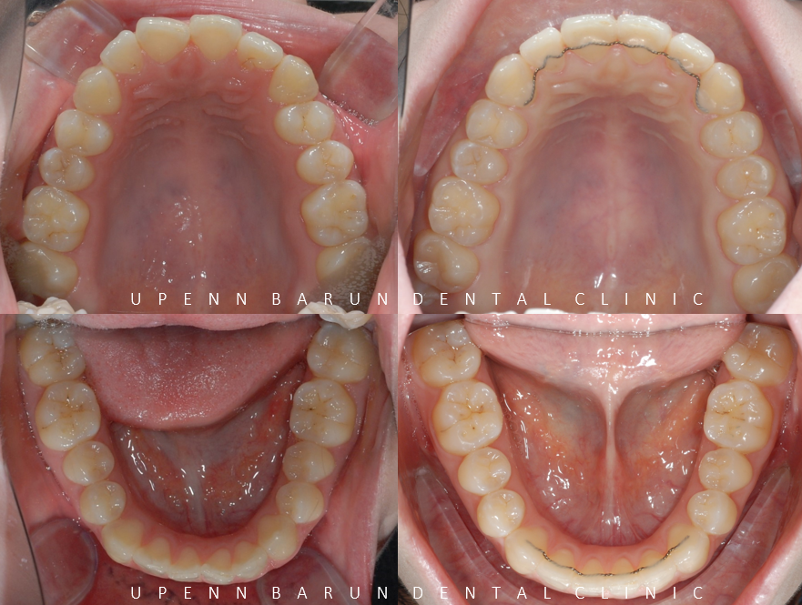 안면비대칭, 잠실수술교정, 잠실양악수술도 유펜바른치과입니다. 관련 이미지 9