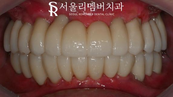 전체 보철을 할 수 밖에 없었던 이유, 서울대입구역 치과 교합 되살리기 관련 이미지 6