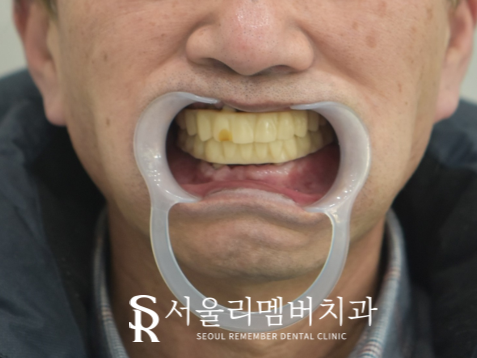 오래된 보철을 방치하면 결국 임플란트 식립밖에 남지 않게 됩니다! 봉천역 리멤버 치과 관련 이미지 6